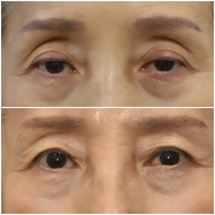 جراحة تدلي الجفون في كوريا قبل وبعد