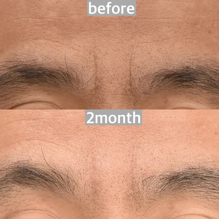 激光治疗改善眉间纹的术前术后对比图
