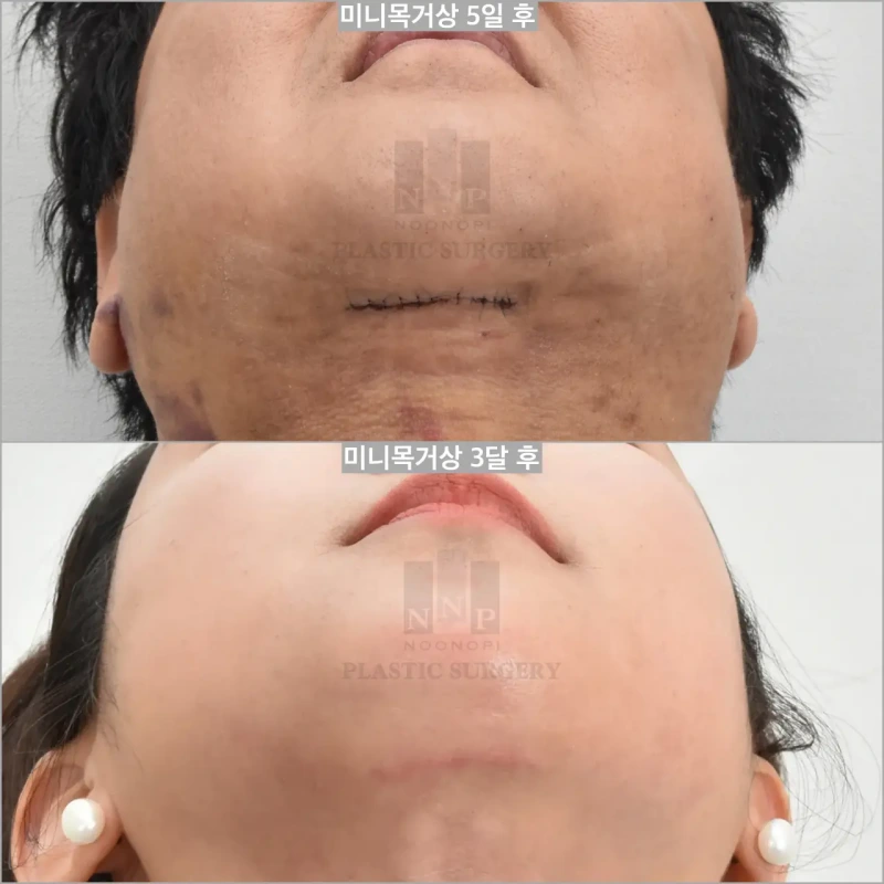 neck scar after 5 days and 3 months
