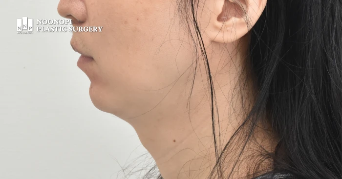 피부 처짐이 심한 풀 목거상 대상 사진