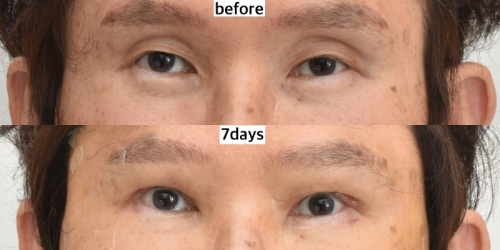 7 أيام بعد جراحة الجفن المتدلي