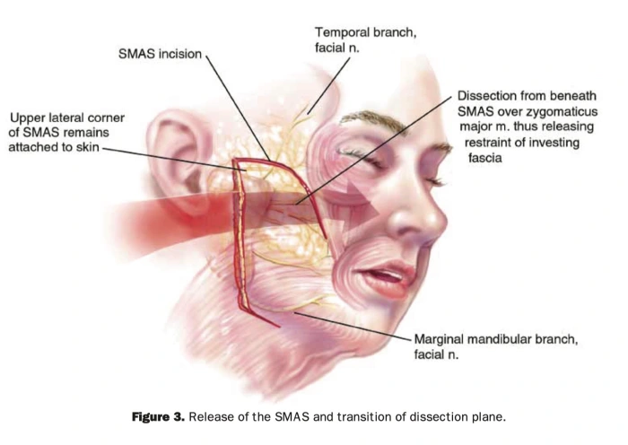 high SMAS facelift by Barton