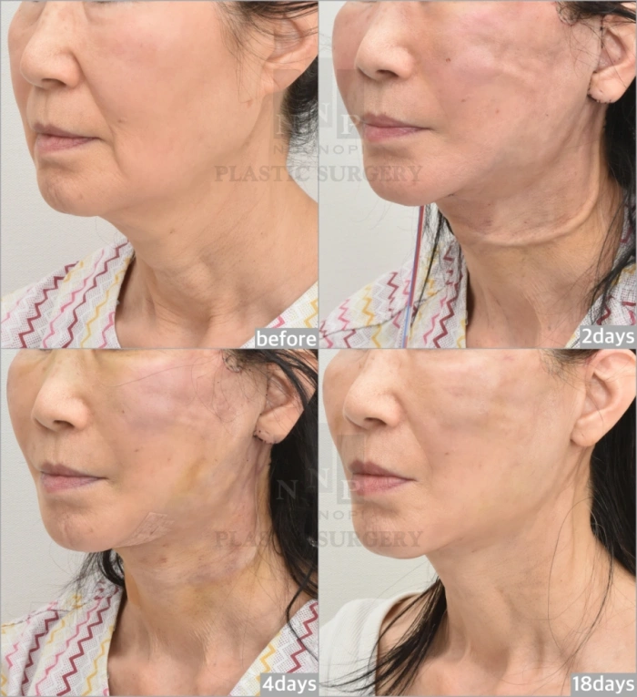 请注意:引流管通常放置2天,于术后第4天移除