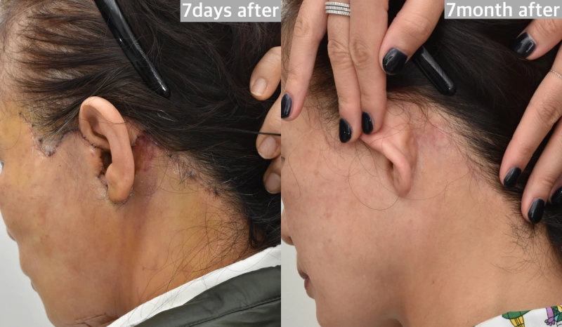 facelift behind ear scar