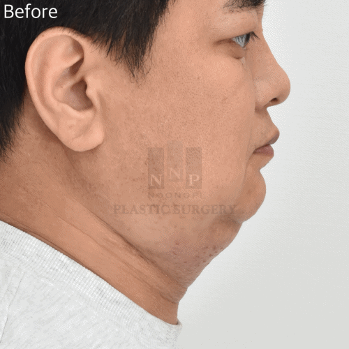 눈높이성형외과의 이중턱 목거상 전후 사례