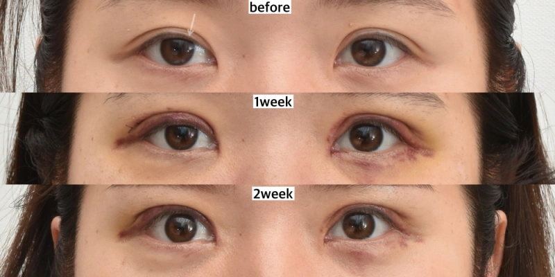 revisional ptosis surgery