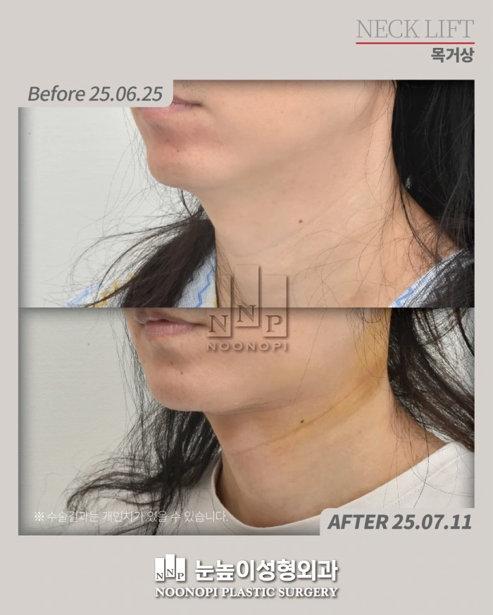 韩国颈部提升术