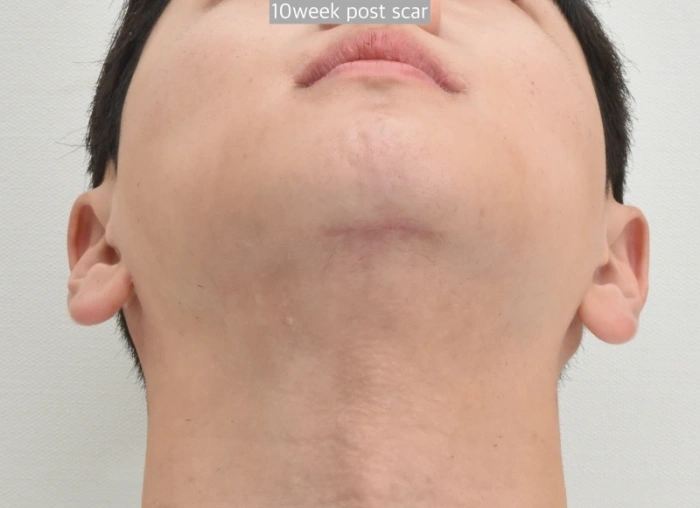 微创颈部提升术疤痕
