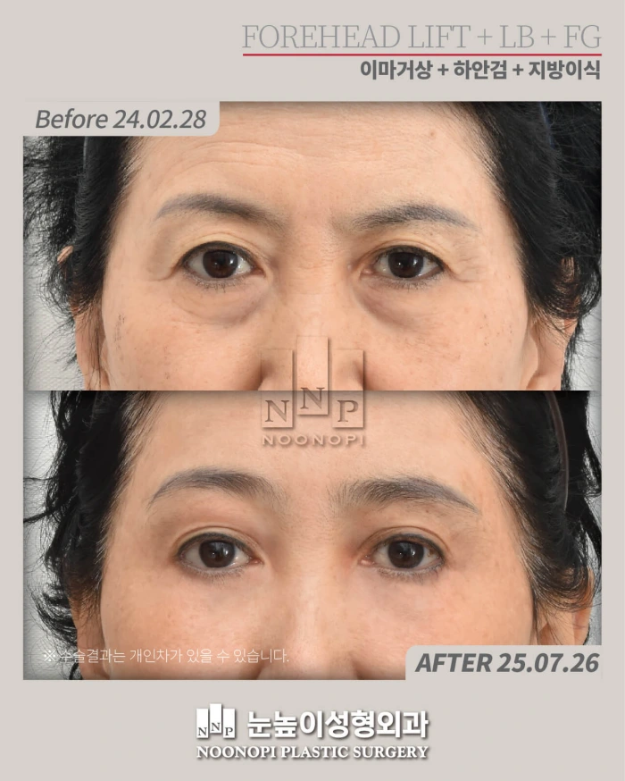 Long-term result of comprehensive upper face rejuvenation including fat grafting