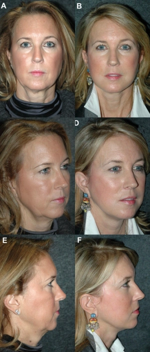 deep plane facelift results