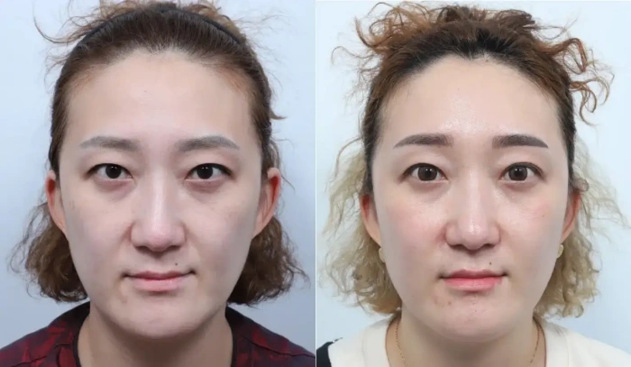 韩国额头提拉术