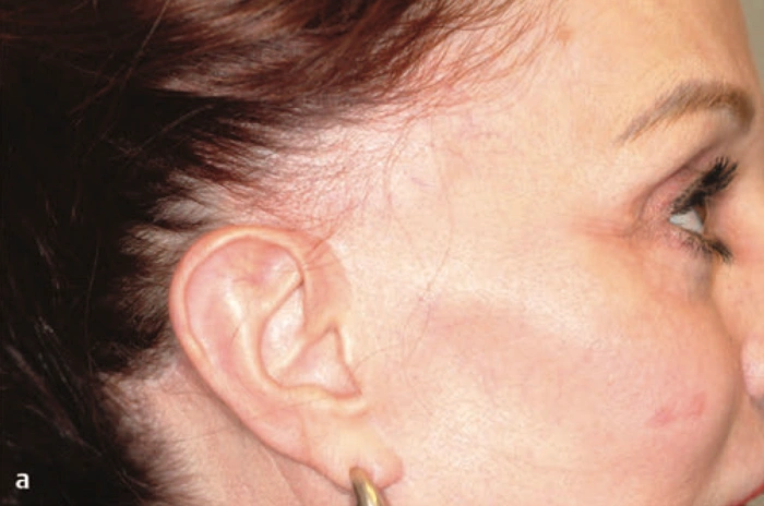 receding hairline after facelift