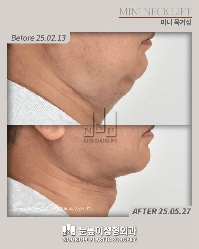 قبل وبعد شد الرقبة المصغر