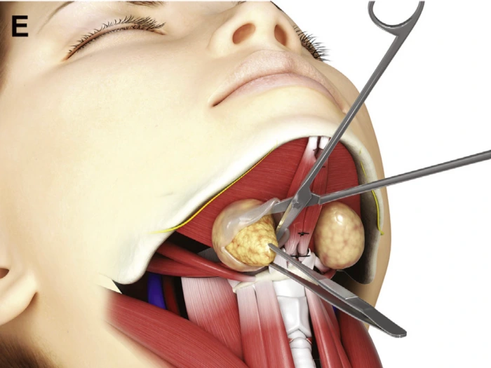 submandibular gland removal