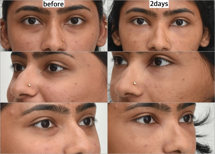 Under-eye fat repositioning, two days after surgery.