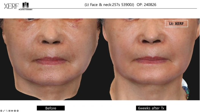 Clinical study XERF safety post facelift