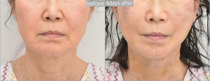 Timeline of facelift Swelling