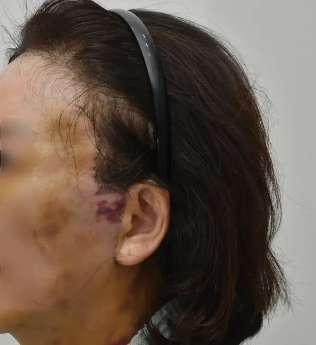 مثال على الندبات أمام شق الصوان (بواسطة جراح مجهول)