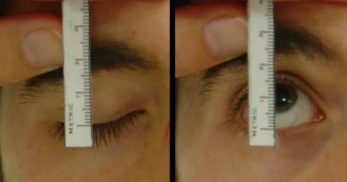 医生在眼睑下垂手术前测试患者提上睑肌功能