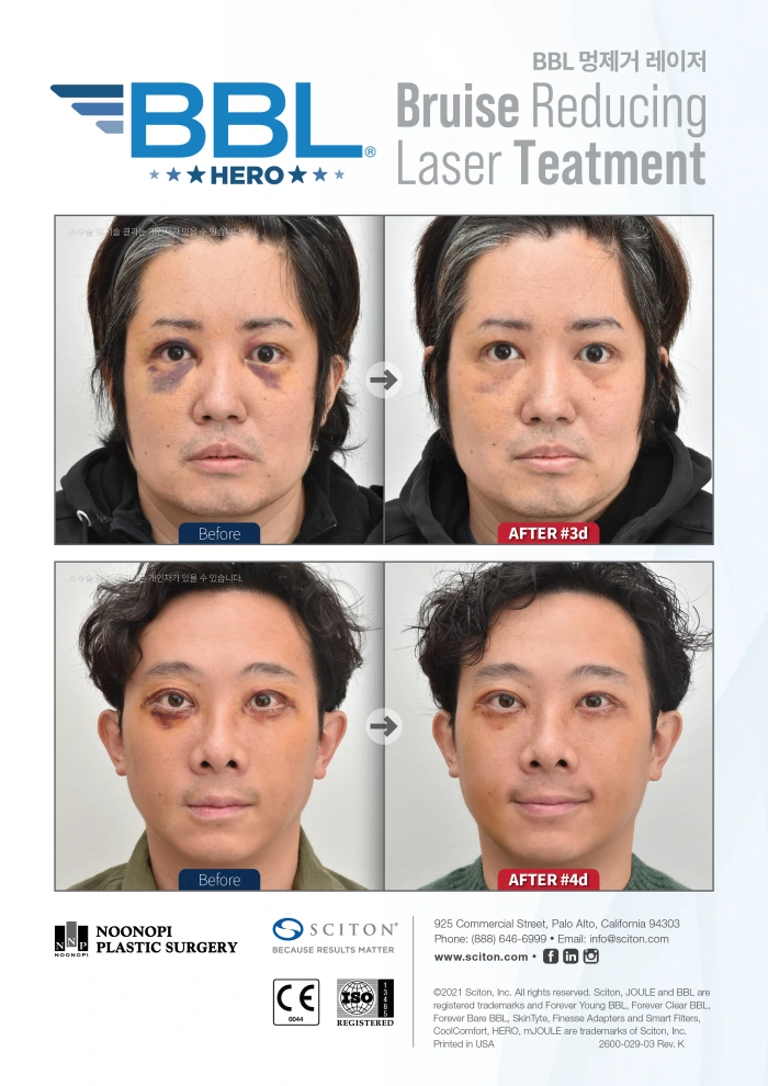 Bruise-Reducing Laser Treatment Results at a Seoul Plastic Surgery Clinic