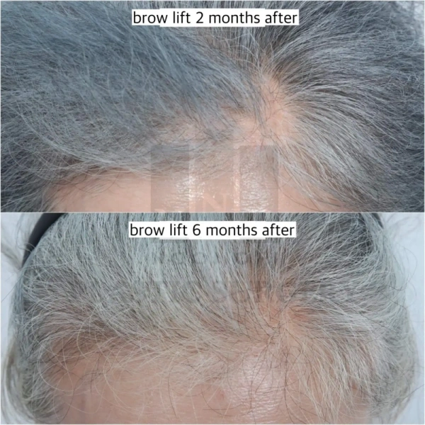 Forehead lift hair loss