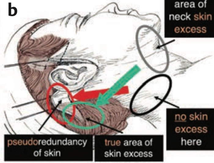 اتجاهات الشد لرفع فعال (من فن الجراحة التجميلية: المبادئ والتقنيات)