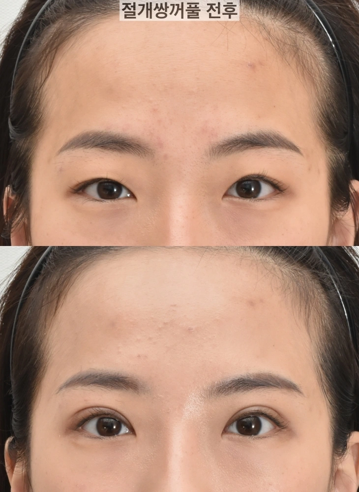 切开双眼皮术前后对比