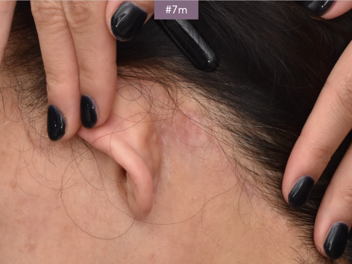 behind ear scar after facelift korea