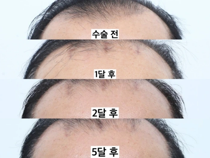 Scar appearance in a patient with hair thinning after brow lift
