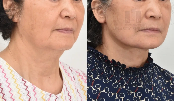 حالة قبل وبعد لـ شد الوجه والرقبة معًا لمريضة في السبعين من عمرها.