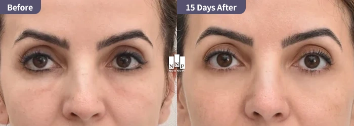Caucasian patient resolving hollowed eyes and aging with lower blepharoplasty and fat grafting at a Gangnam plastic surgery clinic