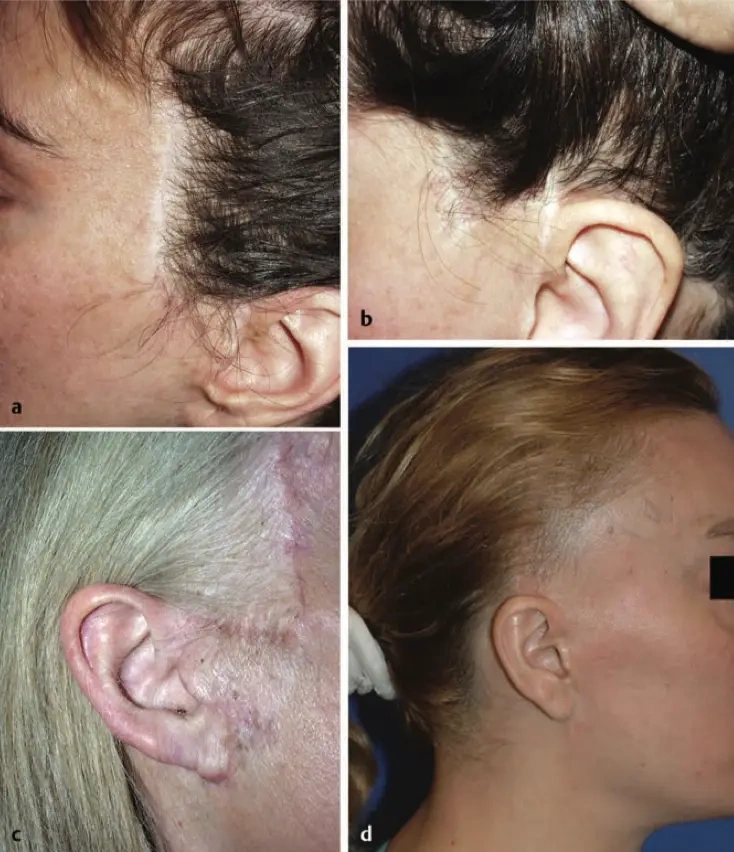 可见疤痕及发际线变形(教科书案例)