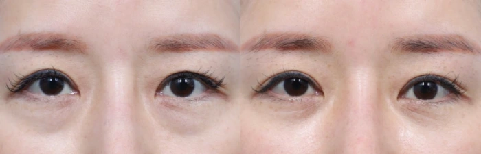 눈밑지방재배치 6주 후 모습