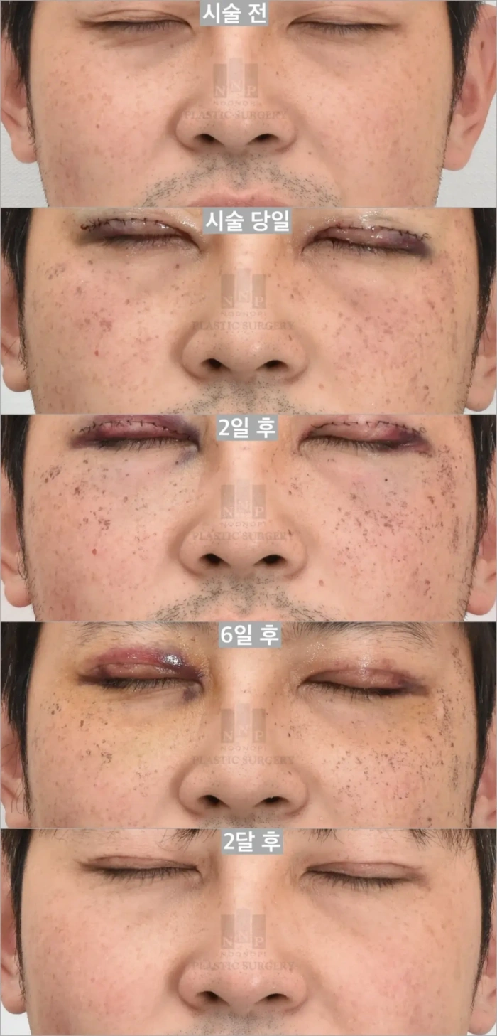 색소치료 비비엘 포에버영 경과