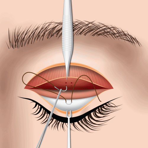 levator advancement ptosis correction illustration