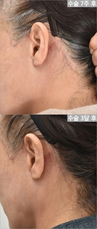 거상흉터 시간지나면서 연해진다