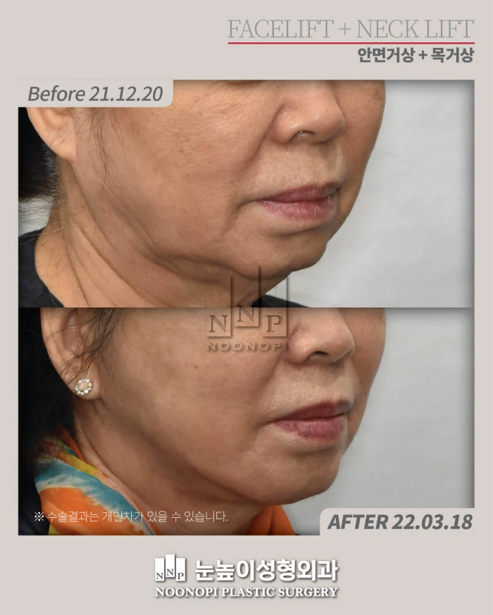 절개거상 전후 모습 사진