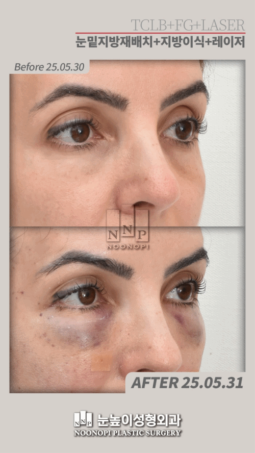 يوم واحد بعد إعادة وضع الدهون + زراعة الدهون تحت العين + تجديد سطح الجلد بالليزر