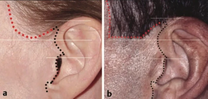 관자 부위 안면거상 절개위치 소개