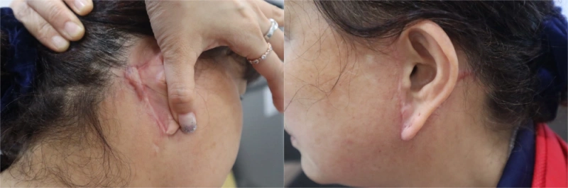 Facelift scars behind the ears