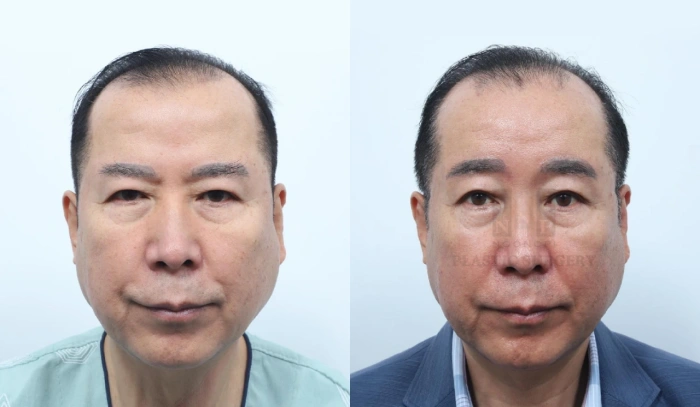 男性眉部提升术前后对比