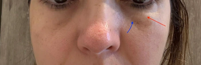 صورة قبل الجراحة: سيتم إعادة وضع الأكياس تحت العين (السهم الأحمر) في منطقة مجرى الدموع (السهم الأزرق) أثناء إجراء إعادة وضع الدهون.