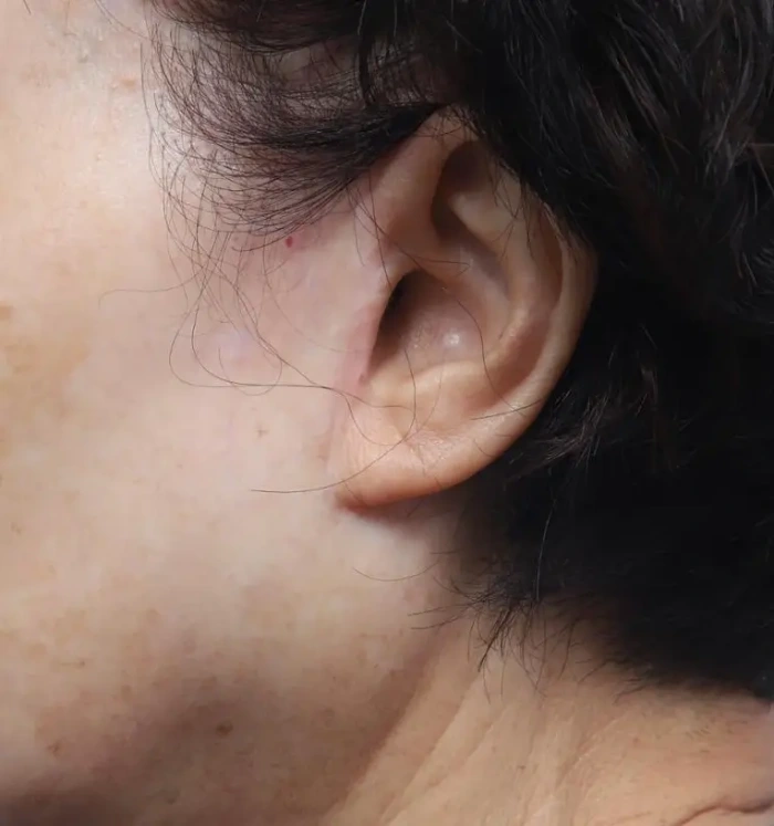 chopped-off tragus