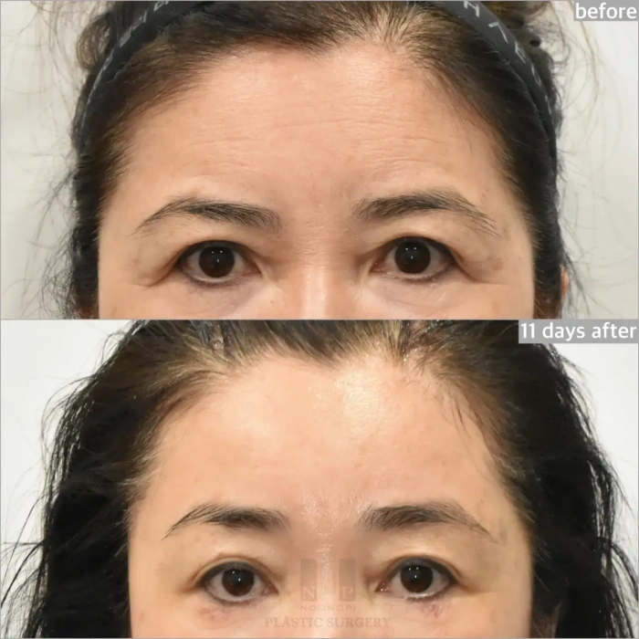 korean endoscopic forehead lift