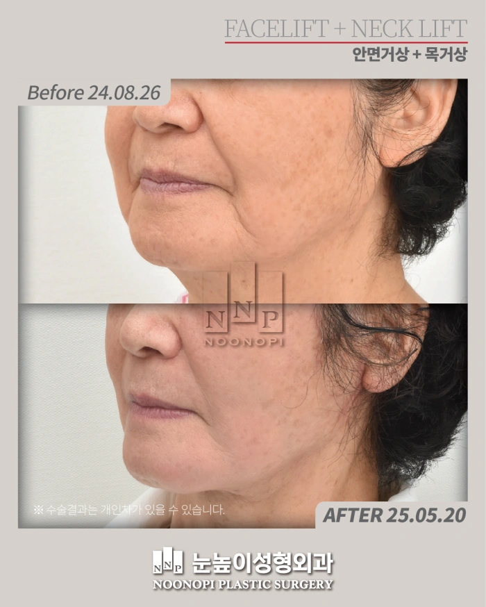 nasolabial fold surgery before after