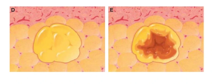 ways to maximize fat survival after fat transfer
