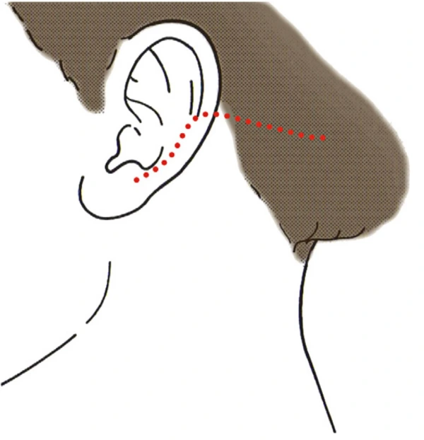 Inside the hairline incision in facelift