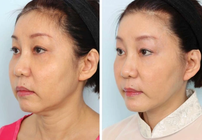 Attached earlobe deformity may look awkward to a discerning eye