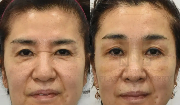 Brow lift post-op recovery photo