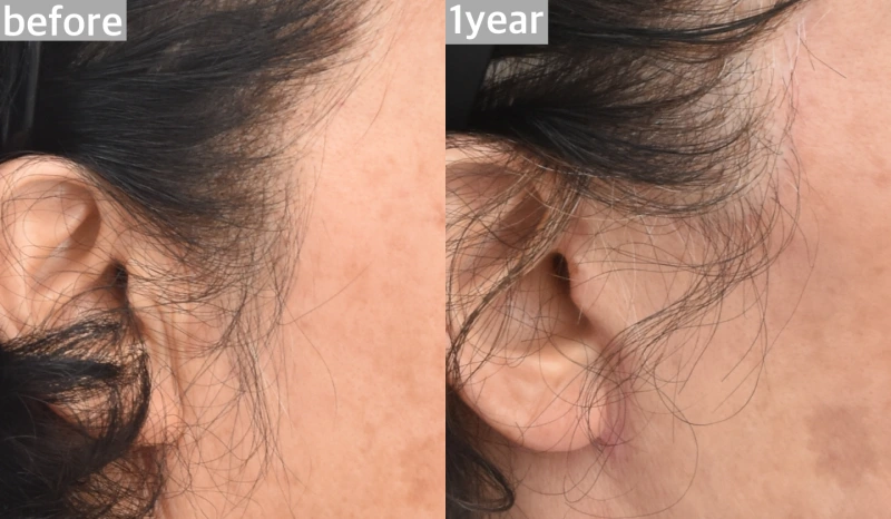 infront of ear scar